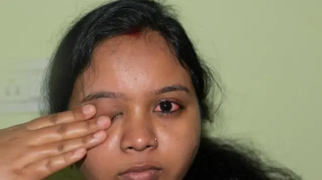 గ్లకోమా