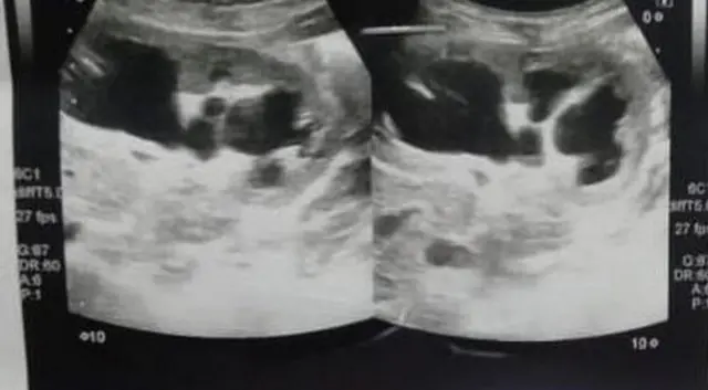 శిశువు ఉదరంలో వికృత పిండాలు