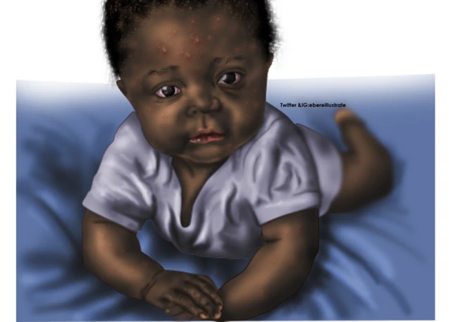 Illustration of baby wey get acne
