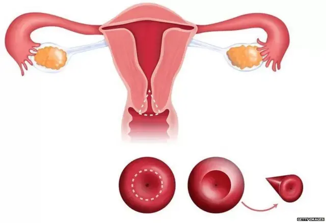 ਸਰਵੀਕਲ ਕੈਂਸਰ