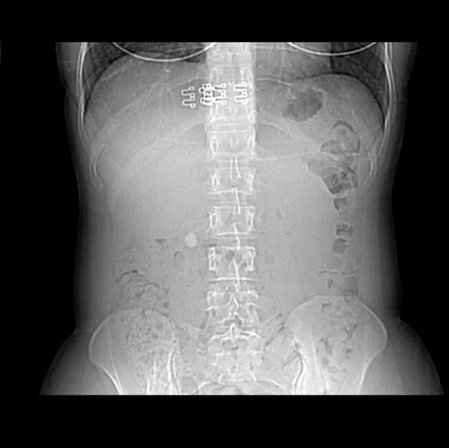 Radiografia de Ginger Smith mostrando uma enorme pedra nos rins