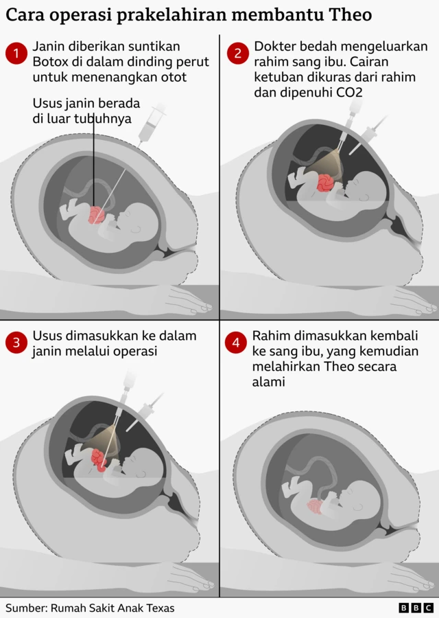 Infografis yang menunjukkan empat langkah operasi prenatal. Janin disuntik Botox di dinding perut untuk mengendurkan otot, ahli bedah sementara membuka rahim dan menggunakan operasi lubang kunci untuk memindahkan usus janin kembali ke dalam tubuh sebelum mengembalikan rahim, memungkinkan kehamilan berlanjut hingga bayi yang sehat lahir secara alami.