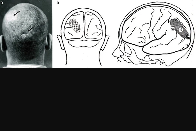 ภาพถ่ายและแผนภาพแสดงให้เห็นแผลเป็นที่ศีรษะ รวมทั้งอาการบาดเจ็บภายในสมอง