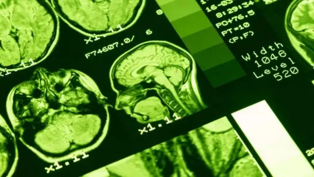 Scanner d'un cerveau.