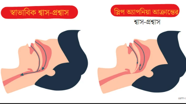 স্লিপ অ্যাপনিয়া হচ্ছে ঘুমানোর সময় শ্বাসনালী কিছু সময়ের জন্য বন্ধ হয়ে যাওয়া।