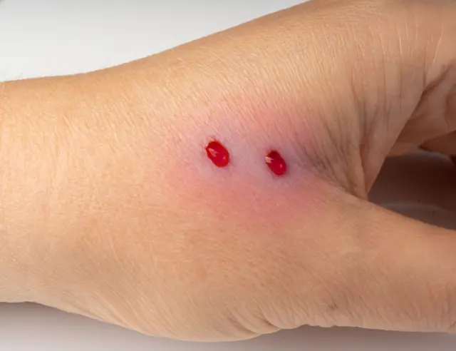 બીબીસી ગુજરાતી, ગુજરાતી, બીબીસી, અમદાવાદ, સાપ, ઝેર, 