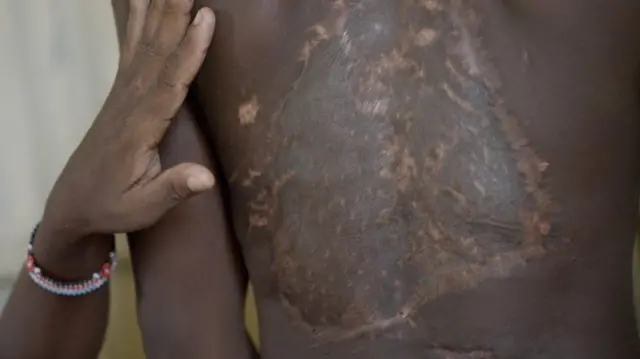 Fred Mwangi yerekana umugongo uriho inkovu w'umuhungu we Caleb