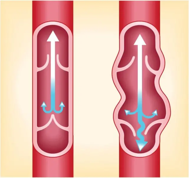 కాళ్లలోని సిరలు