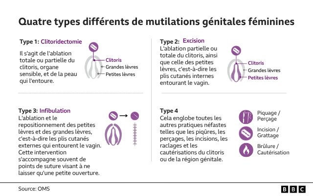 Quatre types différents de mutilations génitales féminines