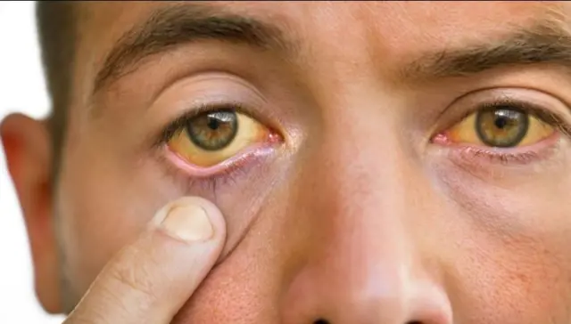 جگر، شراب نوشی، بی بی سی اردو