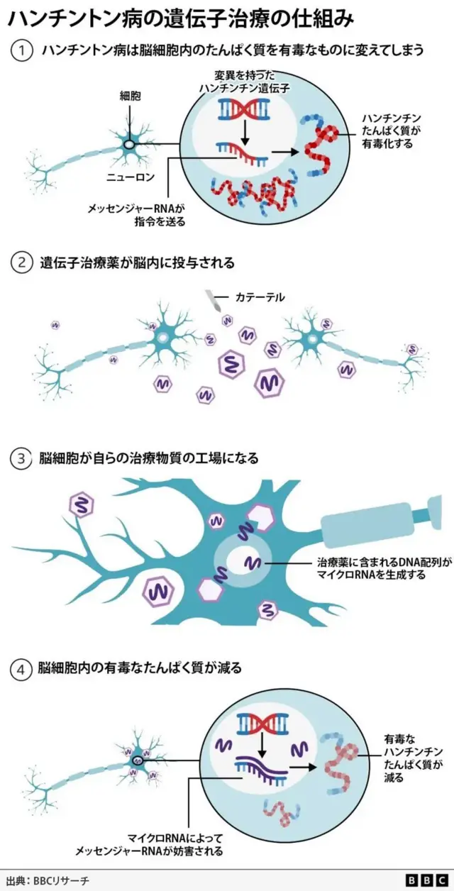 ハンチントン病の遺伝子治療の仕組みが4枚のイラストで示してある。最初のイラストは、脳の神経細胞(ニューロン)を拡大したもので、ハンチントン病が脳細胞のたんぱく質を有毒なものに変えてしまう様子を示している。細胞内にあるDNAの二重らせんが青色で、その中で変異した部分が赤色で描かれている。また、脳細胞内に蓄積した有毒なたんぱく質も赤色で表している。2番目のイラストは遺伝子治療薬の投与を描いていて、2本のニューロンと、カテーテルから投与された複数の六角形のウイルスが描かれている。ウイルスの中には紫色のひも状のものが描かれている。3枚目は、先ほどのニューロンをクローズアップしたもので、中にウイルスが入り込み、紫色のひもを細胞内に放出している様子が描かれている。4枚目は1枚目と同じイラストだが、今度は紫色のひもがDNAの赤かった部分に張り付いて、変異を無効化している。その結果、有毒化したたんぱく質も少なくなっている