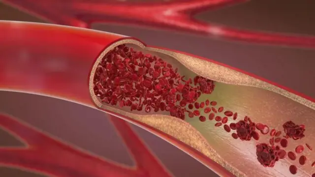 haddii dhiig uu la socdo saxarada (kaas oo noqon kara midab aad u madow) waxay calaamad u noqon kartaa kansarka mindhicirka.