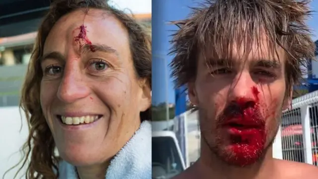 دوپونت و دیوید تصاویر مصدومیت‌هایشان را در شبکه‌های اجتماعی به اشتراک می‌گذارند