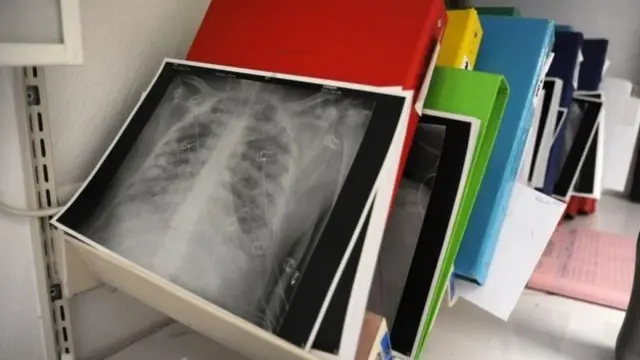 जिवाणू, विषाणू किंवा बुरशीच्या संसर्गामुळे न्यूमोनियाचा फैलाव होतो