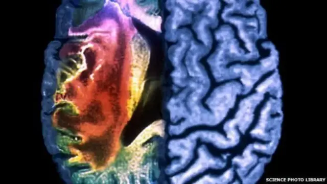 ब्रेन स्ट्रोक