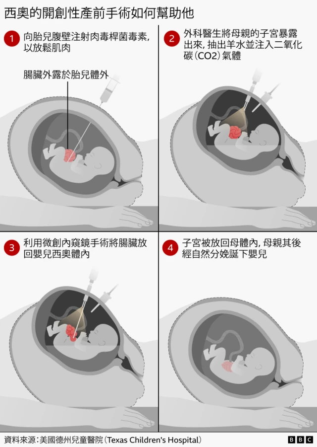 资讯图表显示一项四步骤的产前手术：首先向胎儿腹壁注射肉毒杆菌毒素，以放松肌肉；其后外科医生暂时打开子宫，并利用微创内窥镜手术将胎儿露出体外的肠脏放回体内，然后将子宫复位，让妊娠得以持续，直至健康婴儿经自然分娩出生。