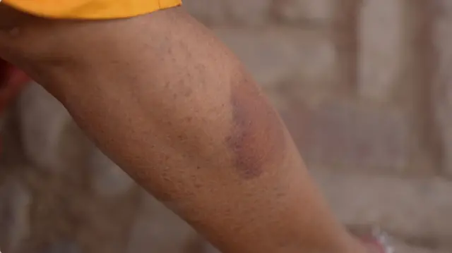 उर्मिला देवी का दावा है कि उन्हें ये चोट उस दिन की लड़ाई में लगी है. हालांकि वो किसी तरह का चिकित्सीय पर्चे नहीं दिखाती