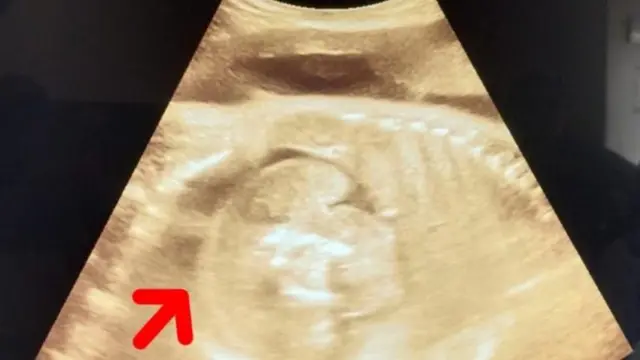 બીબીસી ગુજરાતી, ગર્ભમાં રહેલી બાળકીના પેટમાં બાળક, મહારાષ્ટ્ર, મેડિકલ સાયન્સ