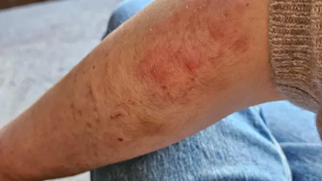 Claire Miller's forearm showing multiple bruises. She is wearing blue jeans and the sleeve of her cardigan is in shot. 