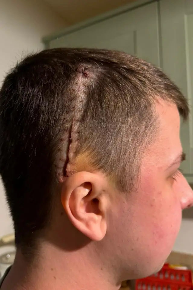 Sisi kepala Josh. Ada belahan rambut yang memperlihatkan luka panjang berjahit berwarna merah serta memar yang terlihat jelas.