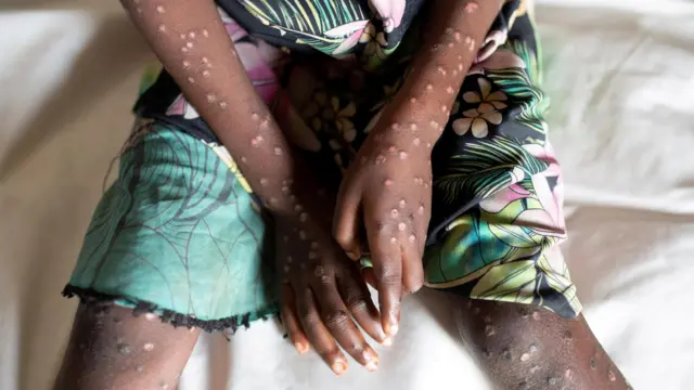 Umwana w'umukobwa w'imyaka 6 arwaye mpox muri Congo mu 2022