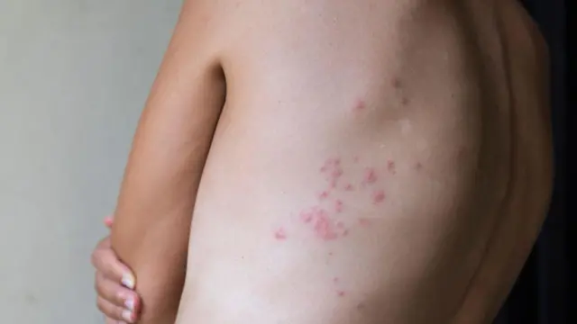 لدغات بق الفراش وردية اللون على ظهر امراءة مصابة.
