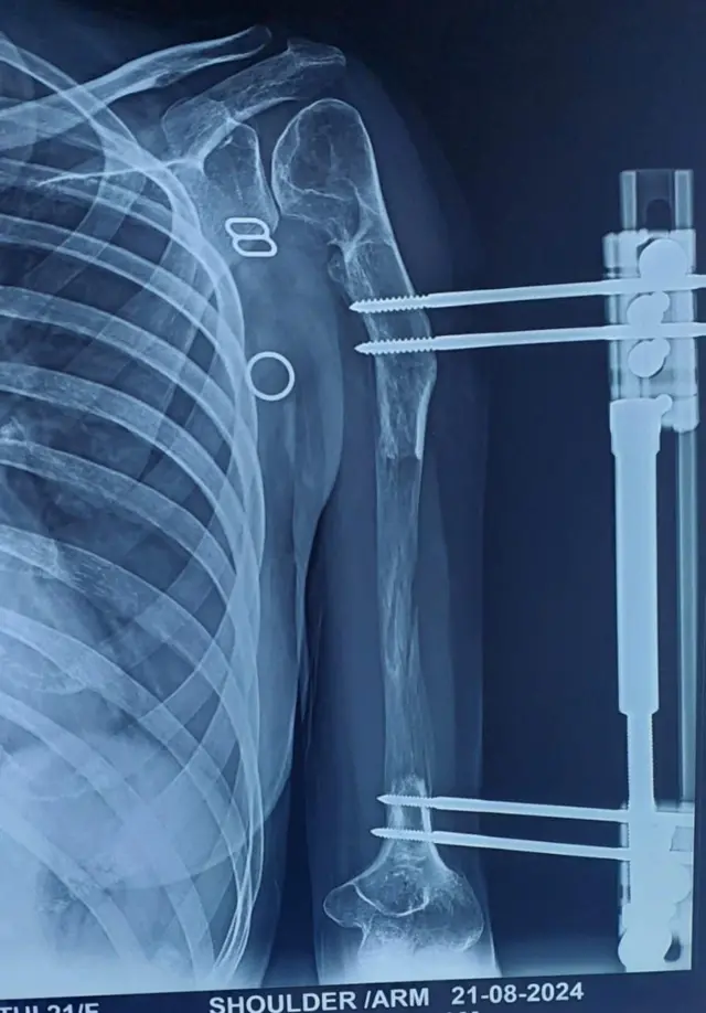 பெண்ணுக்கு 14 செ.மீ. எலும்பை வளரவைத்து அரசு மருத்துவர்கள் சாதனை