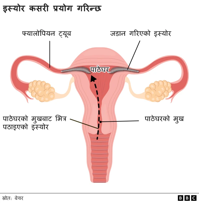 परिवार नियोजनका लागि प्रयोग गरिने उपकरण