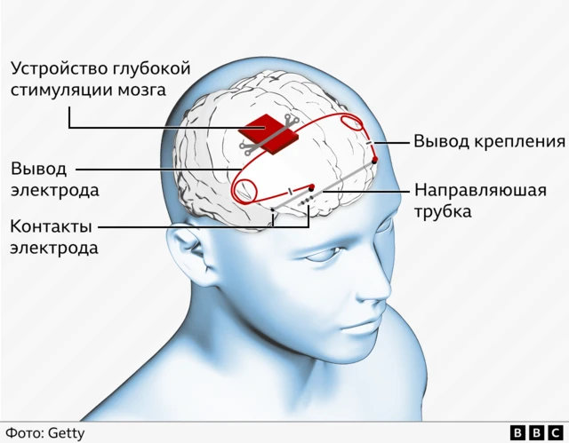 Эпилепсия. Причины и лечение — Новосибирская областная больница Эпилепсия. Причины и лечение — Новосибирская областная больница