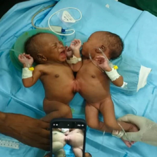 Les siamoise avant le début de l'opération