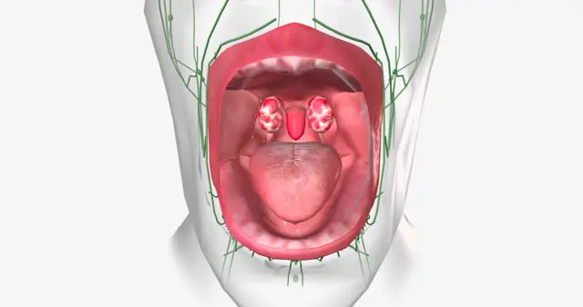የቶንሲል ህመም የሚከሰትበትን ቦታ የሚያሳይ የአፍ የውስጥ ክፍል ምስል