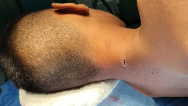 Yan yatırılmış bir genç erkeğin baş, boyun ve omuzlarının fotoğrafı. Boynun arkasında küçük, yarık şeklinde bir yara görülüyor.