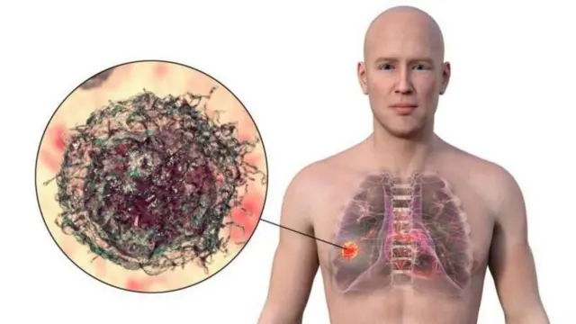 புற்றுநோய்