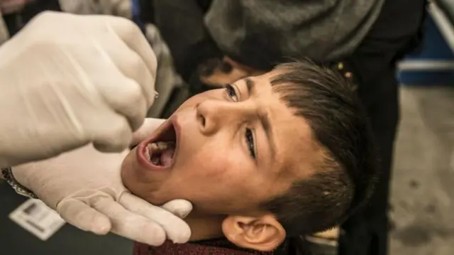 గవదబిళ్ళలు