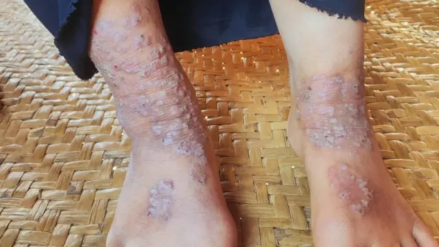 ပေါက်က ကျေးရွာပေါင်း ၁၀ ရွာကျော်က စစ်ဘေးရှောင်တွေ ကူးစက်ခံနေရ