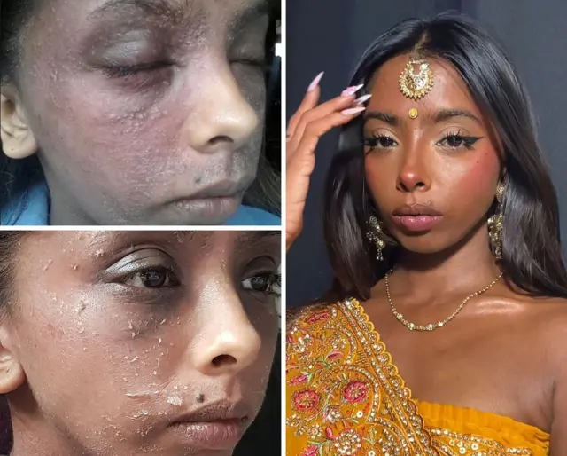 Three pics of Karishma at different stages of her TSW journey. In the top left image her face is swollen, inflamed with a rash, her eyes are closed and she looks in pain. In the bottom left image image her skin is peeling from her face. In the larger right image, her skin is clear and she is wearing make up. She looks very healthy.