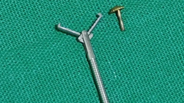 நுரையீரலில் சிக்கிக்கொண்ட மூக்குத்தி திருகு