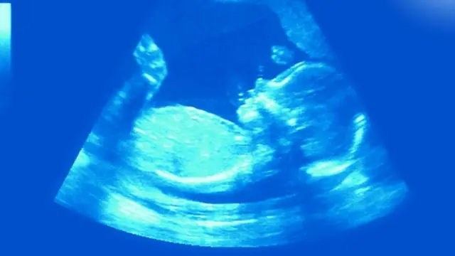 விக்கல்