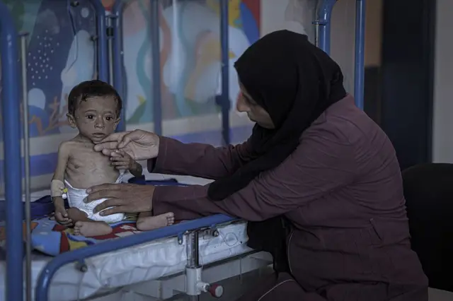 ஊட்டச்சத்து குறைபாட்டால் பாதிக்கப்பட்ட குழந்தையின் புகைப்படம்