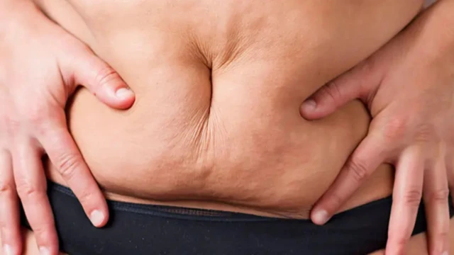 सी-सेक्शन सर्जरी के बादत उभरा हुआ पेट