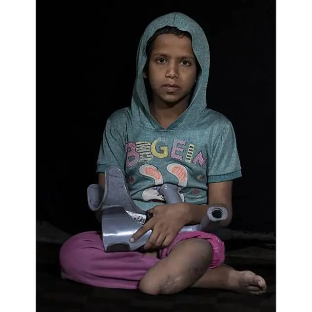 Un niña de 10 años sentada. Su pierda izquierda fue amputada tras un ataque israelí.