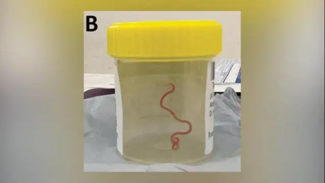 दिमाग में कीड़ा