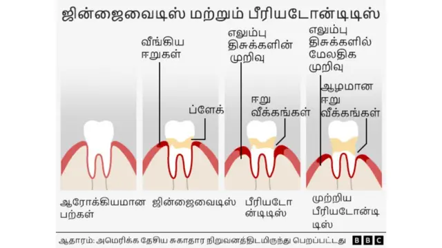 பற்கள் ஆரோக்கியம், வாய் துர்நாற்றம், ஈறு நோய்