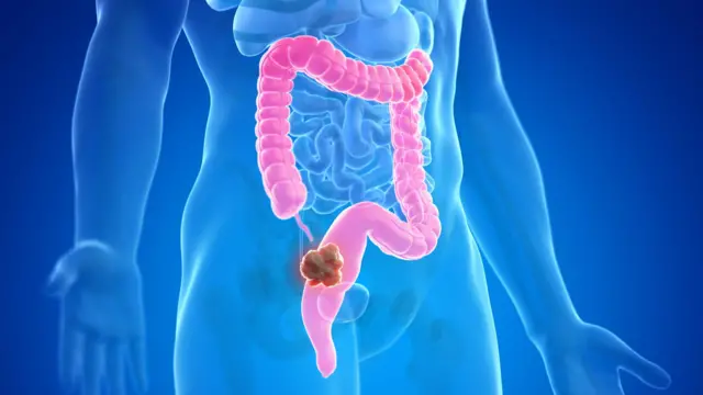 Ilustração mostrando câncer de cólon no corpo humano