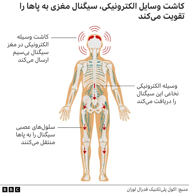 ایمپلنت مغزی