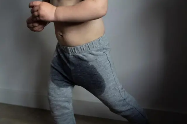 પેશાબ કર્યાની થોડી સેકન્ડો પછી અથવા શૌચાલય બહાર નીકળ્યા બાદ અચાનક પેશાબના ટીપાં પડે તેને પોસ્ટ મિક્ટુરિશન ડ્રિબલ (પીએમડી) કહેવામાં આવે છે.