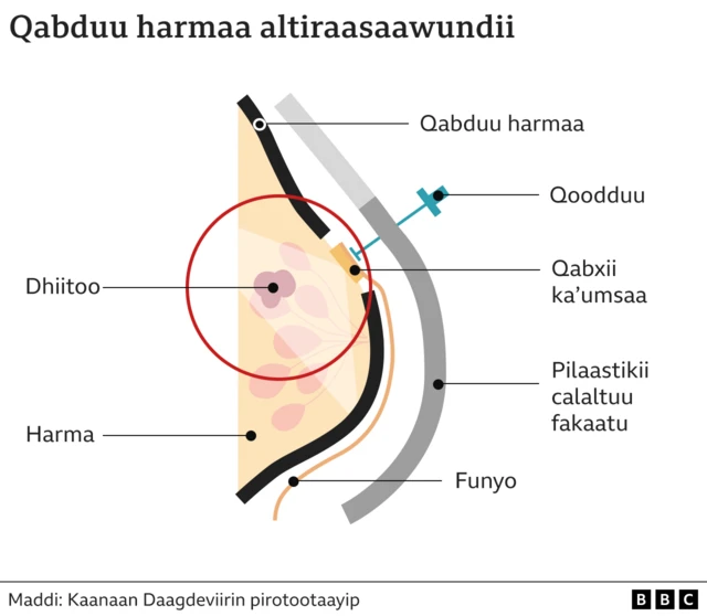 Mala akka qabduu harmaatti kaansarii adda baasu 