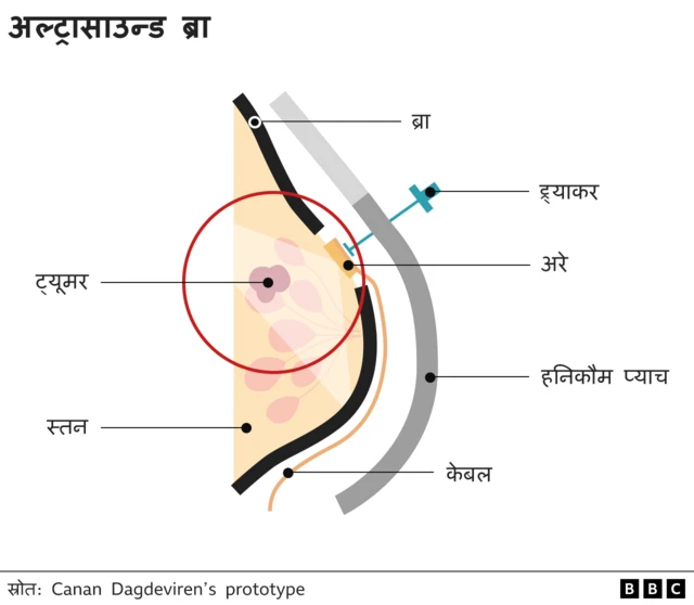 अल्ट्रासाउन्ड ब्रा