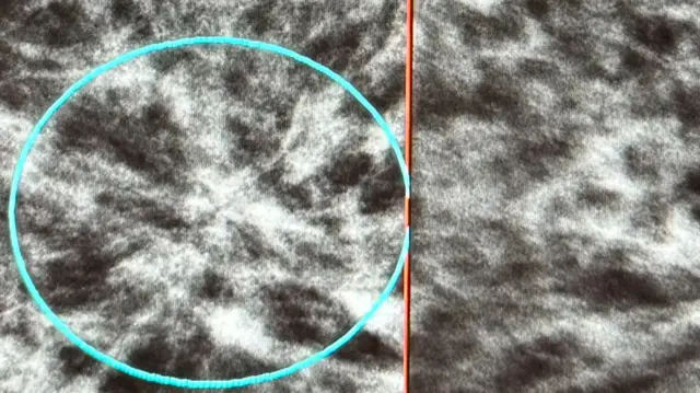 這是一張非常清晰的乳癌腫瘤黑白影像。它有一個小綠圓圈來指出它。