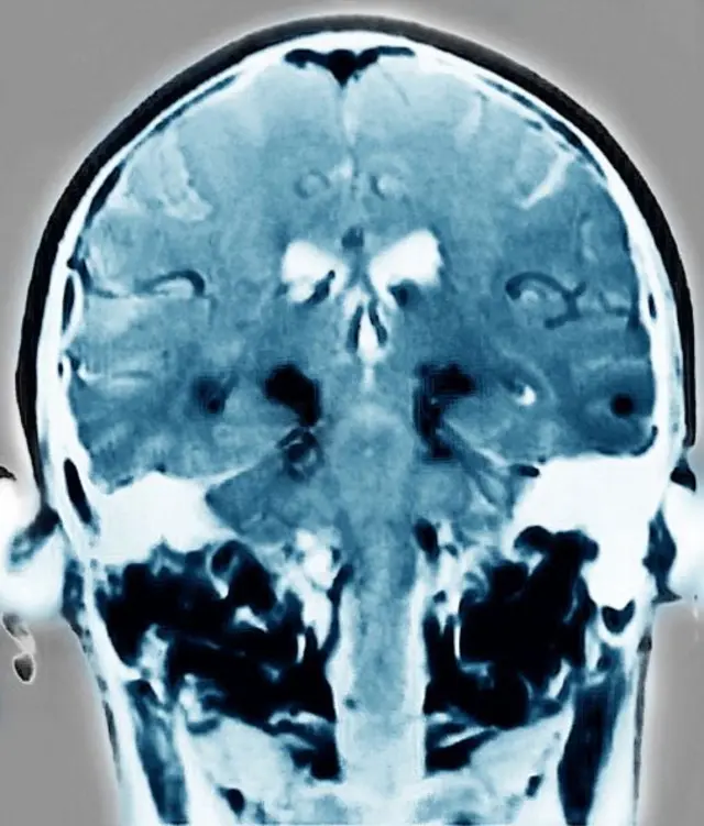 పార్కిన్సన్స్ బాధితుడి తల ఎంఆర్ఐ స్కాన్